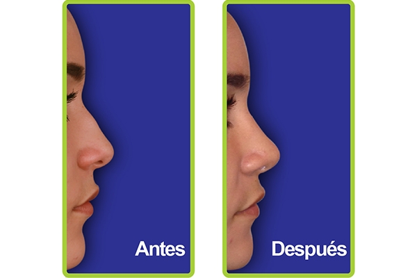 nariz_casos_1