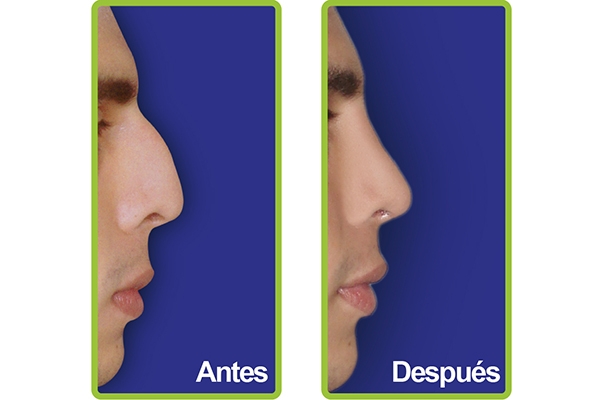 nariz_casos_10
