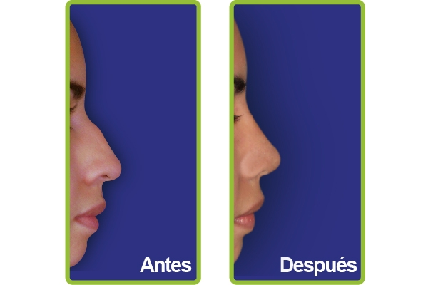 nariz_casos_11