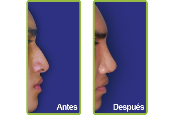 nariz_casos_12