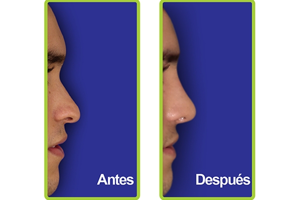 nariz_casos_2