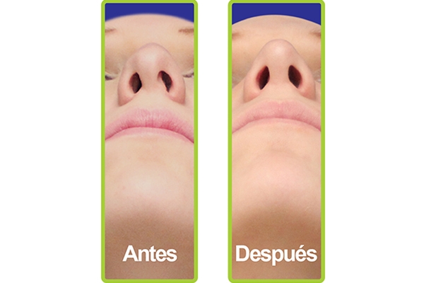 nariz_casos_5