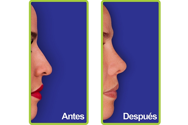 nariz_casos_7